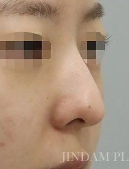 -韩国真谈整形驼峰鼻和鼻尖下垂矫正手术分享，真的很惊艳！