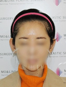 韩国女性发际线移植图片:毛莱茵植发的发际线这么好看!