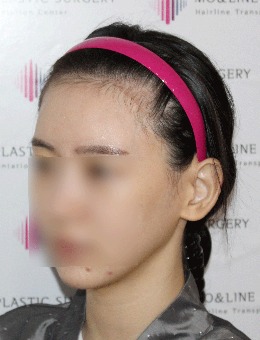 -种植发际线前后对照图:毛莱茵植发女性发际线移植太自然了吧!
