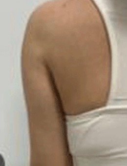 韩国N-Slim做吸脂术超棒，手臂明显好看了！_术后