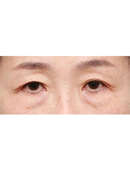 韩国LIVELY整形外科帮你解决眉毛下垂问题！_术前