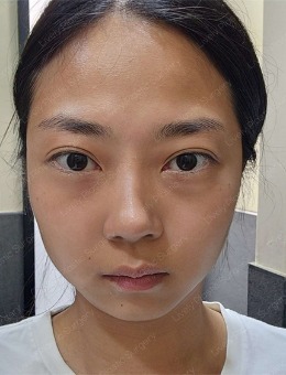 去韩国LIVELY整形外科做眼袋手术，不会后悔！_术前