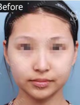 韩国Snow医院面吸2件套对比:脸颊嘴角+双下巴吸脂后气质大变!_术前