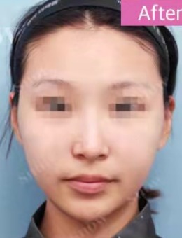 韩国Snow医院面吸2件套对比:脸颊嘴角+双下巴吸脂后气质大变!_术后
