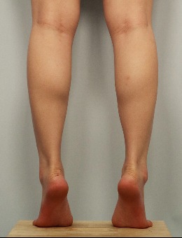 -分享我在韩国toxnfill整形医院做瘦腿术的全过程,附对比图！