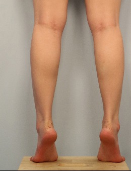 分享我在韩国toxnfill整形医院做瘦腿术的全过程,附对比图！