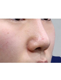 在韩国玲克整形外科做鼻子整形手术前后的对比!