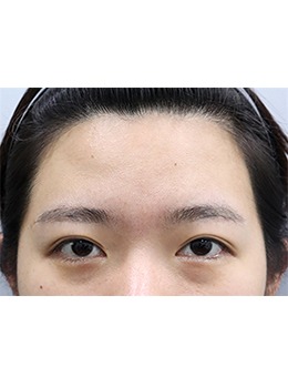 韩国玲克整形尹栋炫医生做面部提升手术前后对比!