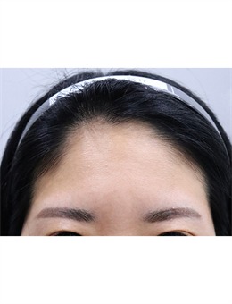 分享韩国玲克整形额头拉皮手术前后对比图_术前