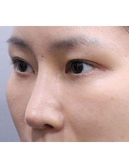 -年轻五岁不是梦！和大家分享韩国玲克整形的眼袋消除术！