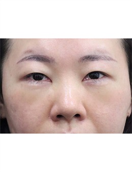 韩国玲克整形眼下脂肪重置手术解决眼部多种问题