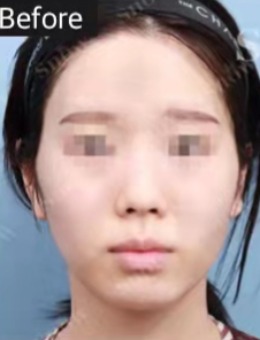 韩国snow整形外科面部脂肪填充帮您轻松打造爱心精致脸！