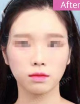 韩国snow整形外科面部脂肪填充帮您轻松打造爱心精致脸！