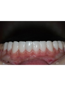看韩国SNOW牙科牙齿贴面给你展现黄牙消失术_术后