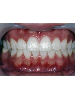 韩国sonw牙科的“一日牙齿美白”让你吸睛数爆表！_术后