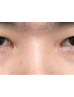 -分享韩国SONE整形外科眼角修复术!眼角疤痕统统不见
