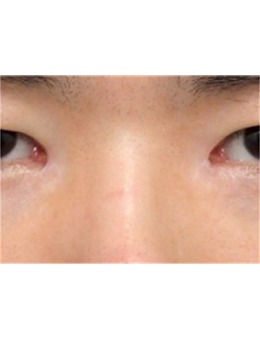 分享韩国SONE整形外科眼角修复术!眼角疤痕统统不见