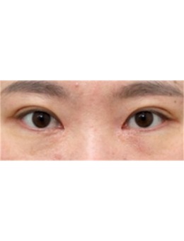 墻裂分享韓國sone眼修復手術前后對比圖,點擊有驚喜喲_術后