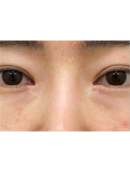 雙眼皮修復哪家好?來看看韓國sone整形眼修復對比圖吧!_術后