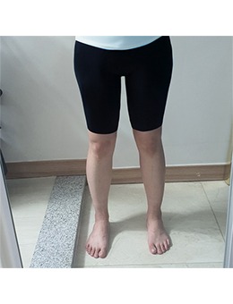 手术图片分享~韩国普兰斯瘦腿前后对比惊人!