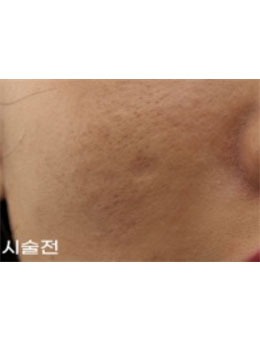 韩国露潭韩医院祛疤技术真牛，脸上疤痕完全看不见了！_术前