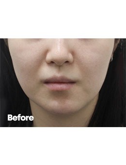 韩国Reyou皮肤科inmode线提升术前术后对比图分享，变化很明显！_术前