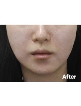 韩国Reyou皮肤科inmode线提升术前术后对比图分享，变化很明显！_术后