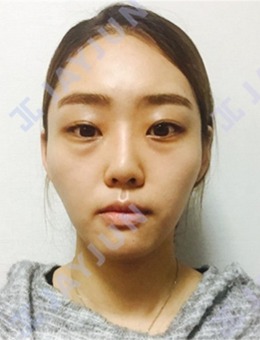 记录我在韩国jayjun整形外科做轮廓+鼻子+眼袋全过程!_术前