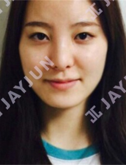 韩国jayjun整形外科怎么样,轮廓/双眼皮/隆鼻是特色附真人对比图!