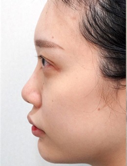 韩国美舒雅整形做的鼻综合手术带来的变化也太大了!_术前