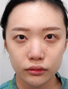 韩国美舒雅整形带你了解鼻子对面部的影响有多大!附真人对比图~