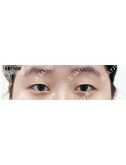 眼部提肌矯正有用嗎?來看韓國jayjun整形外科真人對比圖就懂啦!
