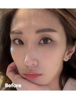 韩国Reyou皮肤科面部玻尿酸填充,圆你改头换脸的梦