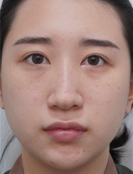 韩国整鼻子就找美舒雅整形外科,看我姐妹术前术后气质大变样！