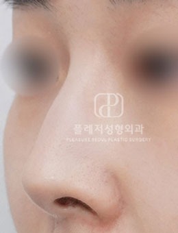 韩国褔莱泽pleasure整形外科做鼻部矫正真给力,铁粉真实分享!_术前