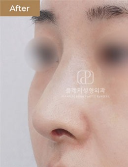 韩国褔莱泽pleasure整形外科做鼻部矫正真给力,铁粉真实分享!_术后