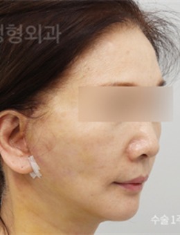 -在韩国V.LIF比丽普整形外科做的面部提拉改变太大了！好喜欢！