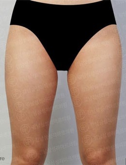 -韩国PetitParty整形腿部吸脂对比图分享，变化明显！