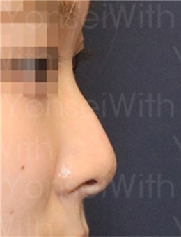 韩国延世white耳鼻喉科隆鼻对比图，简直太惊艳！_术前