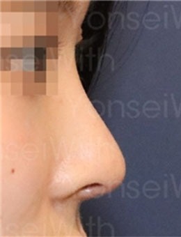 韩国延世white耳鼻喉科隆鼻对比图，简直太惊艳！_术后