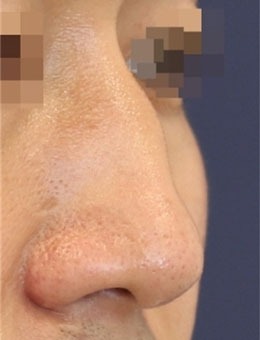 在韩国延世white耳鼻喉科做了驼峰鼻矫正，恢复的特别好！