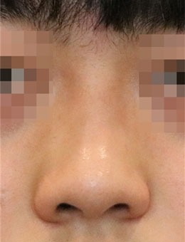 韩国延世white耳鼻喉科隆鼻手术真的好，看看对比图！