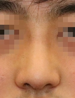 韩国延世white耳鼻喉科隆鼻手术真的好，看看对比图！_术后