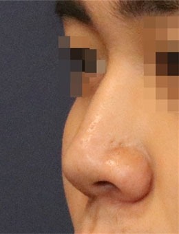 -在韩国延世white耳鼻喉科做了鼻部矫正，很值得推荐！