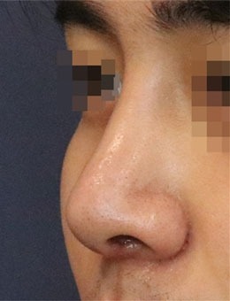 在韩国延世white耳鼻喉科做了鼻部矫正，很值得推荐！_术后