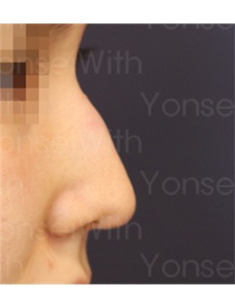 鼻梁上的小山怎么改善？还得看韩国延世white耳鼻喉科
