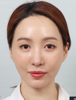 分享韩国petitparty整形面部提升手术图片，术后真好看！_术前