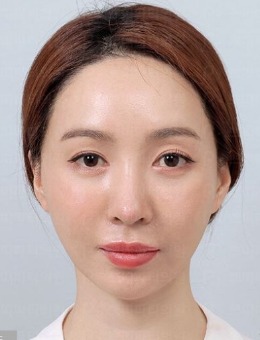 -分享韩国petitparty整形面部提升手术图片，术后真好看！