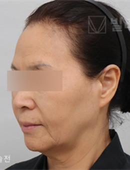 脸部皮肤下垂松弛如何改善？韩国V.LIF比丽普整形外科真人对比！
