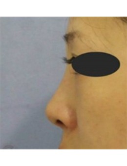 个性化鼻整形还得韩国SONE整形外科,审美好/不违和
